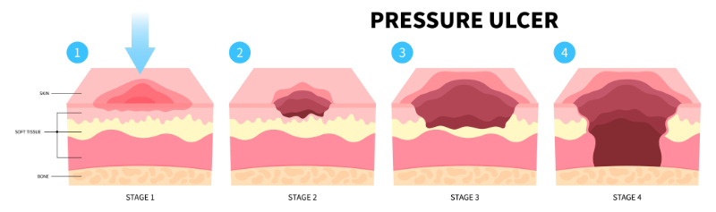 graphic showing different pressure point positions