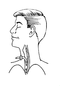 Tracheostomy